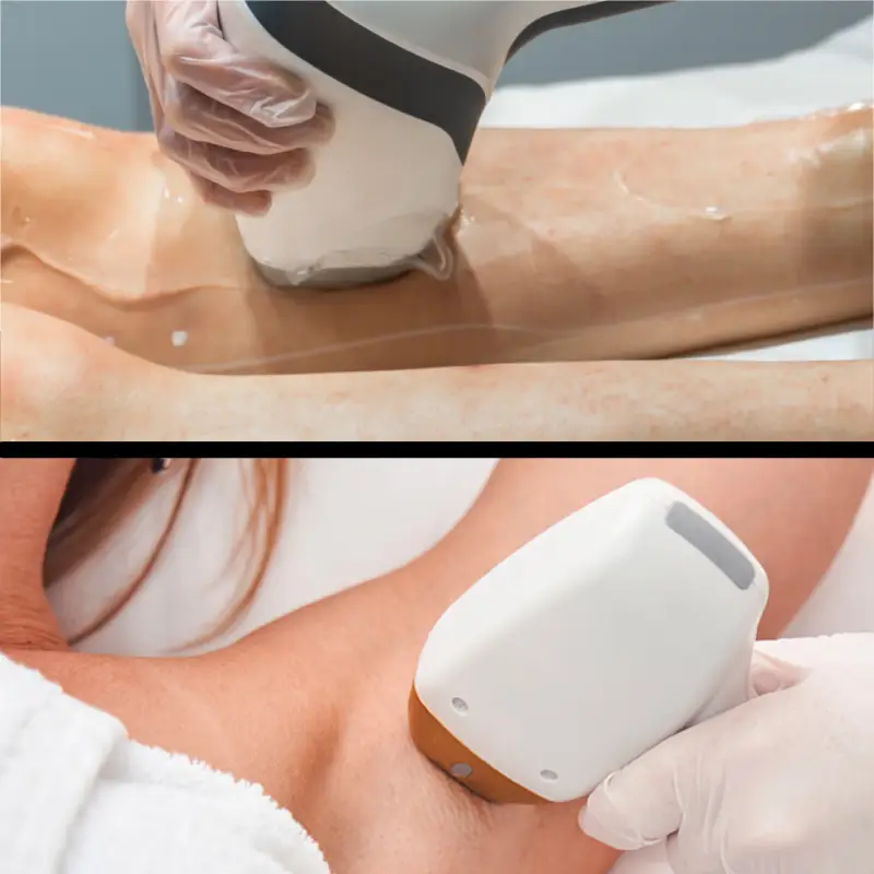 épilation laser à nancy et à Metz aisselles demi jambes