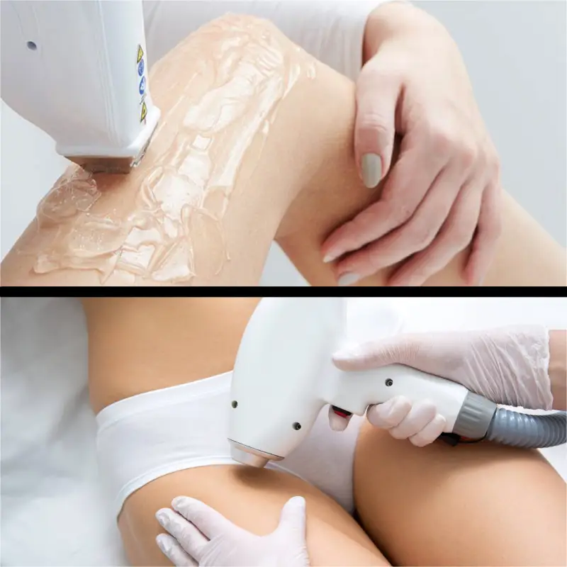 épilation laser maillot jambes entières nancy et metz