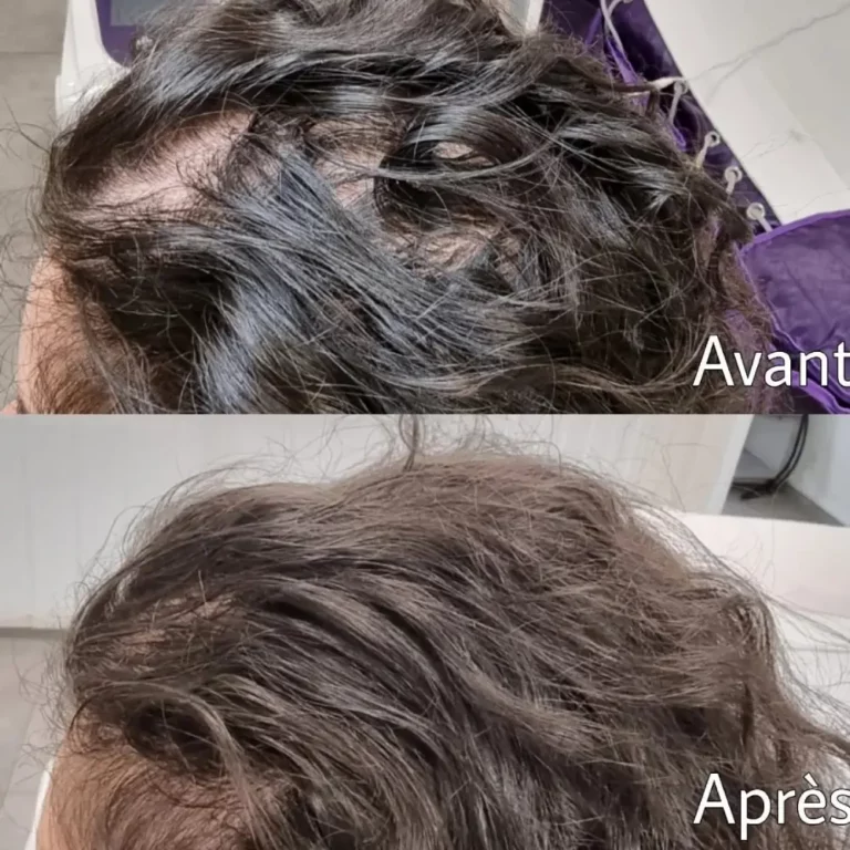 Deep Shoot avant après croissance cheveux solution à la pelade