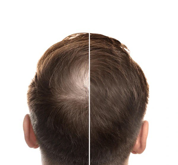 Jetpeel : soin cheveux anti chute