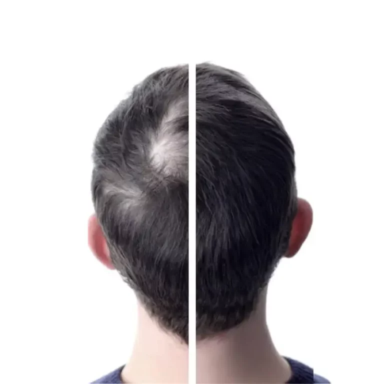 Deepshot : soin cheveux anti chute