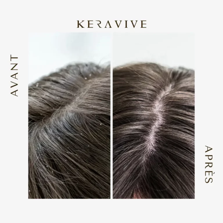 keravive avant après