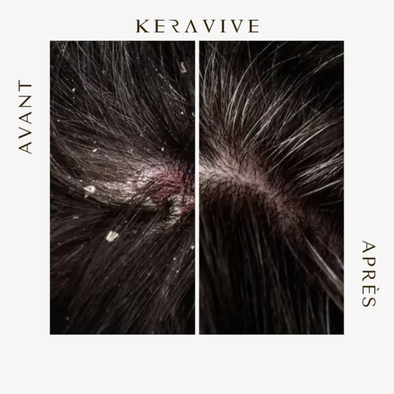 keravive avant après anti pelliculaire